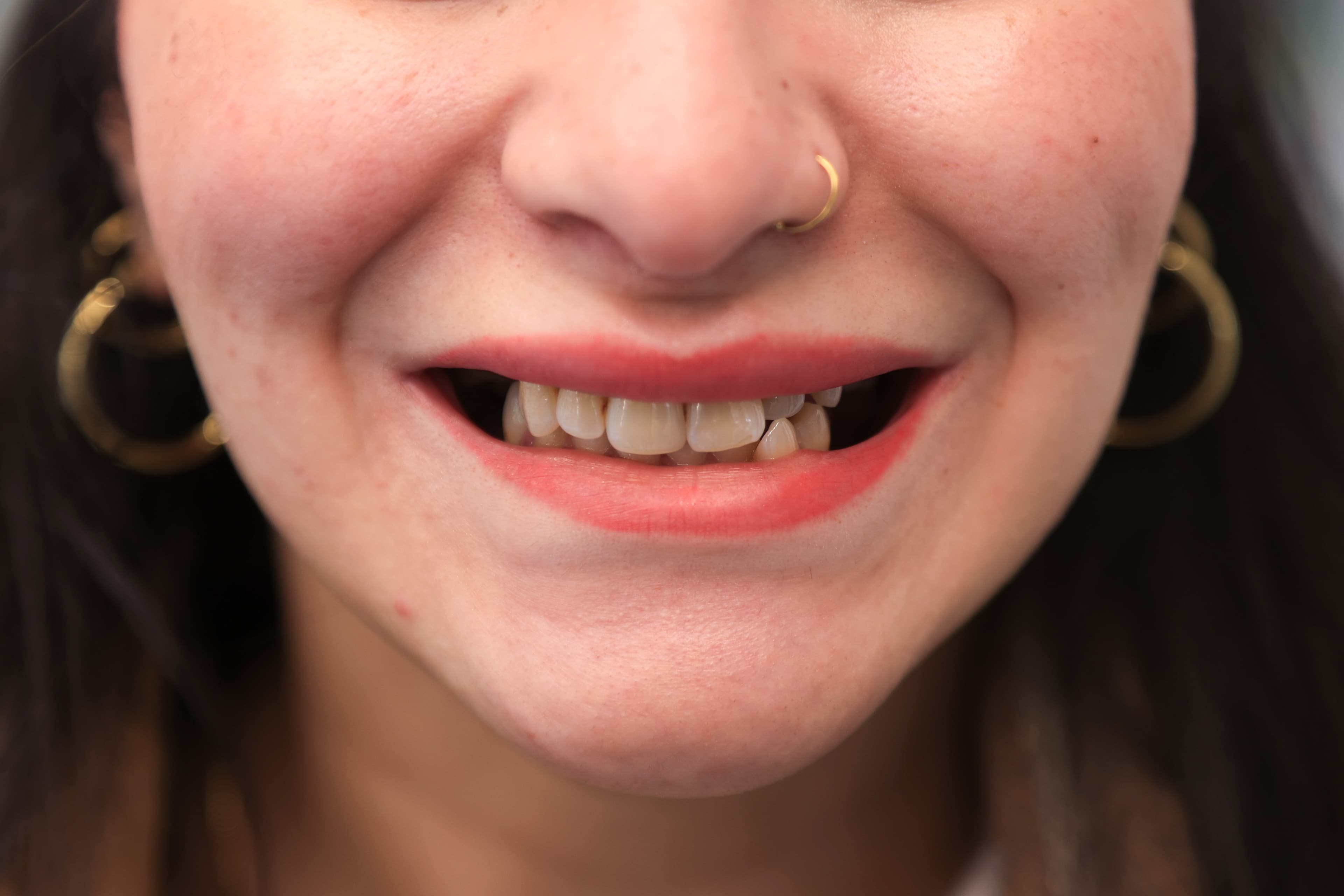 Lela Dental before and after treatment result before