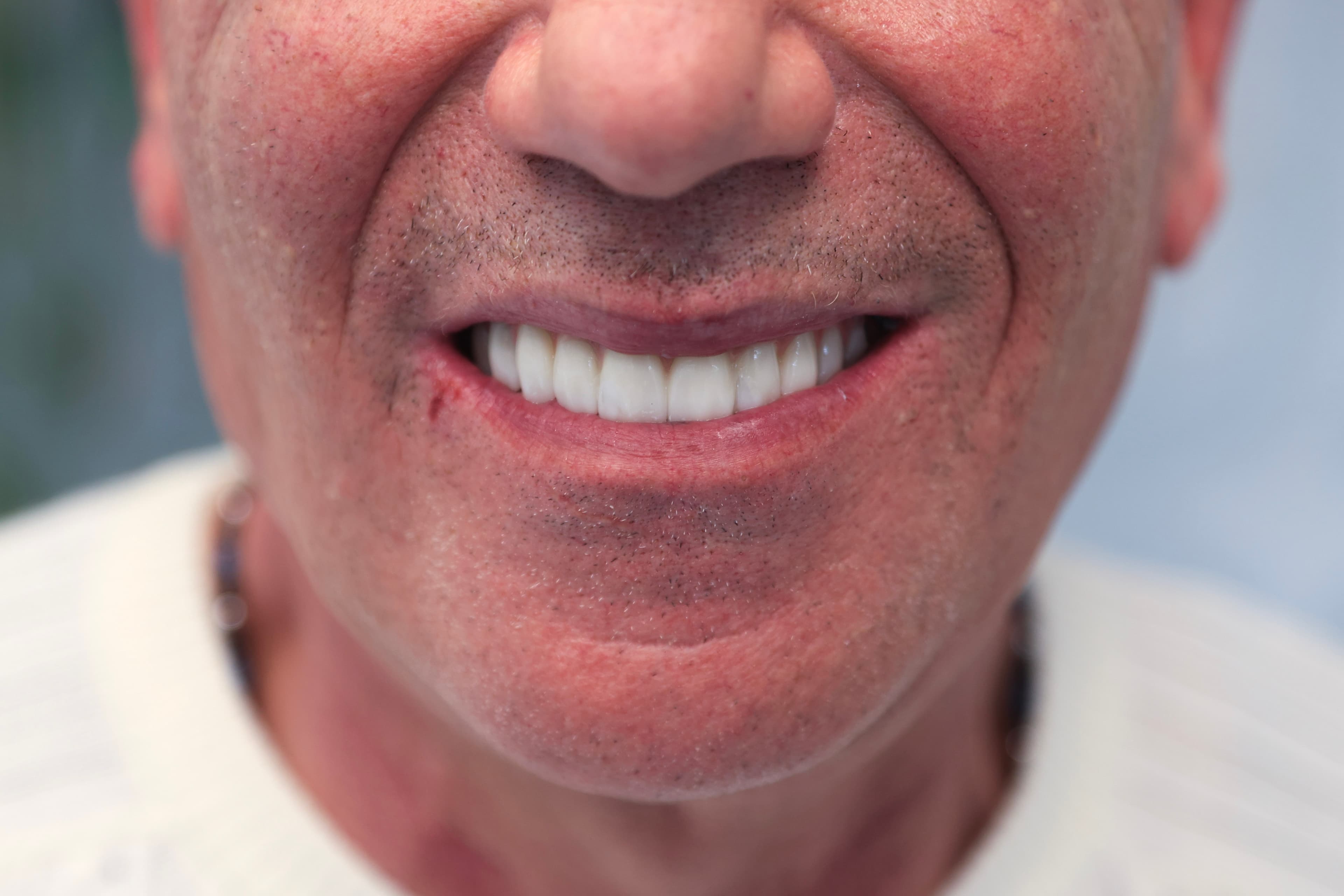 Lela Dental before and after treatment result after