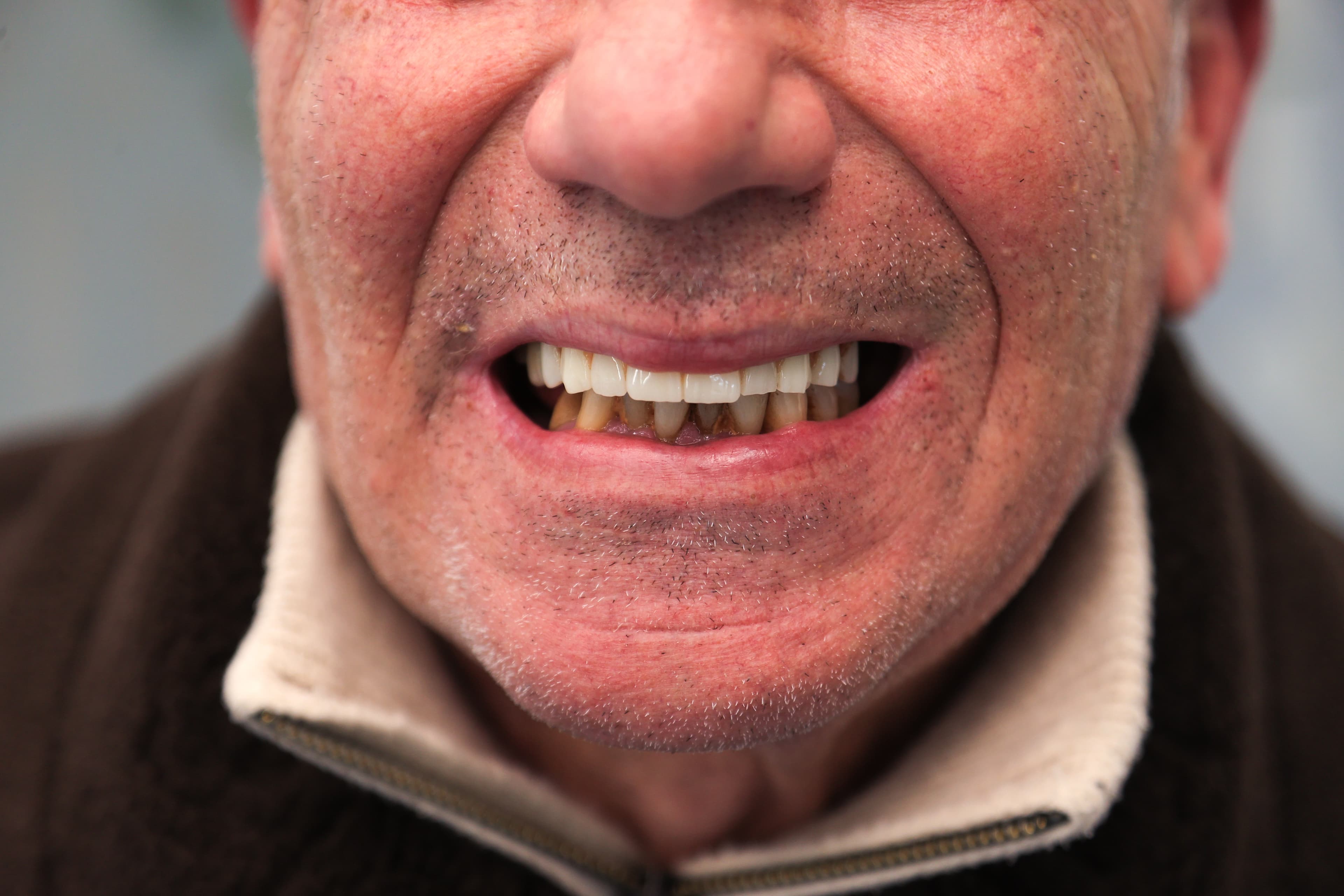 Lela Dental before and after treatment result before