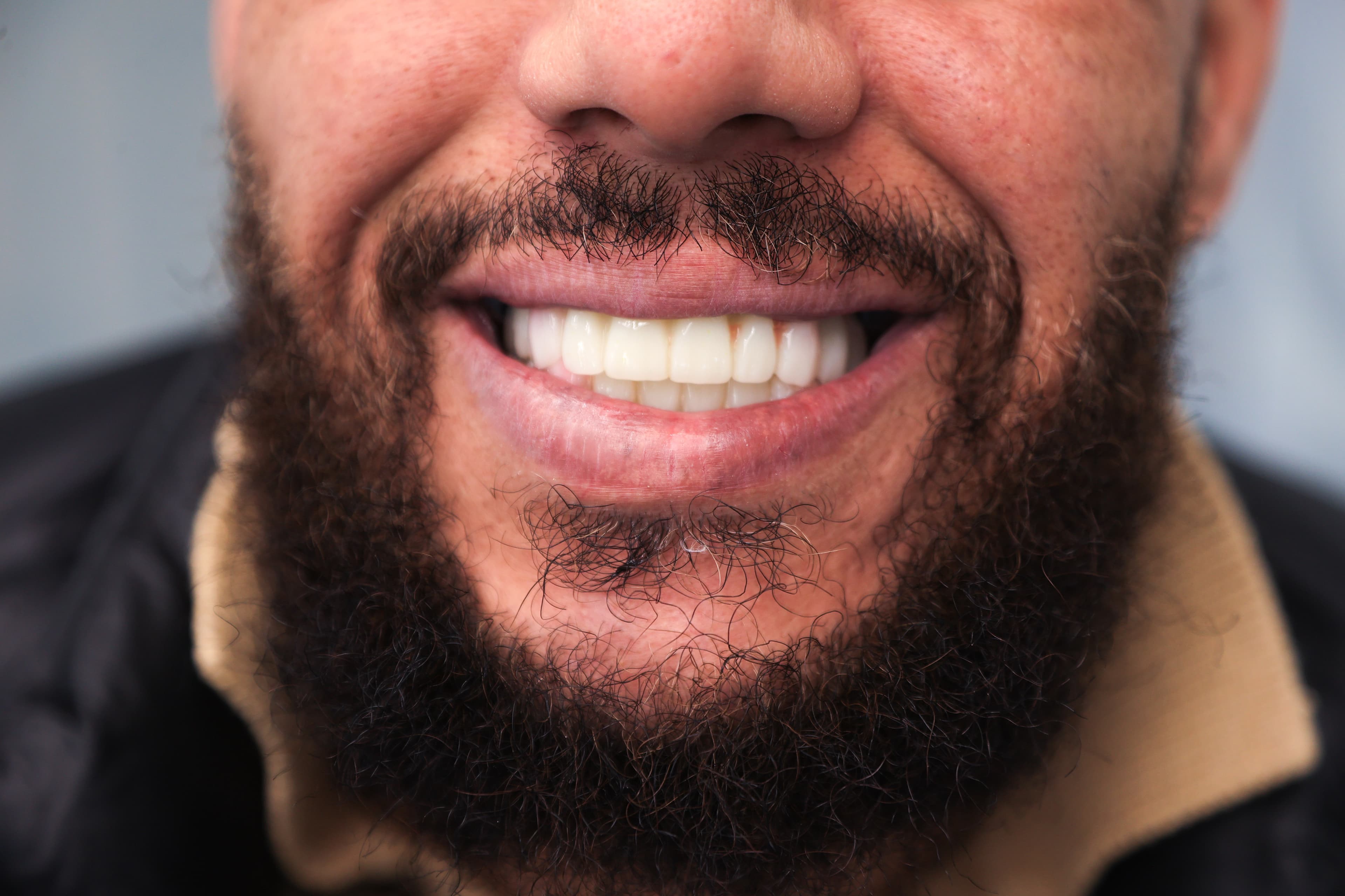 Lela Dental before and after treatment result before