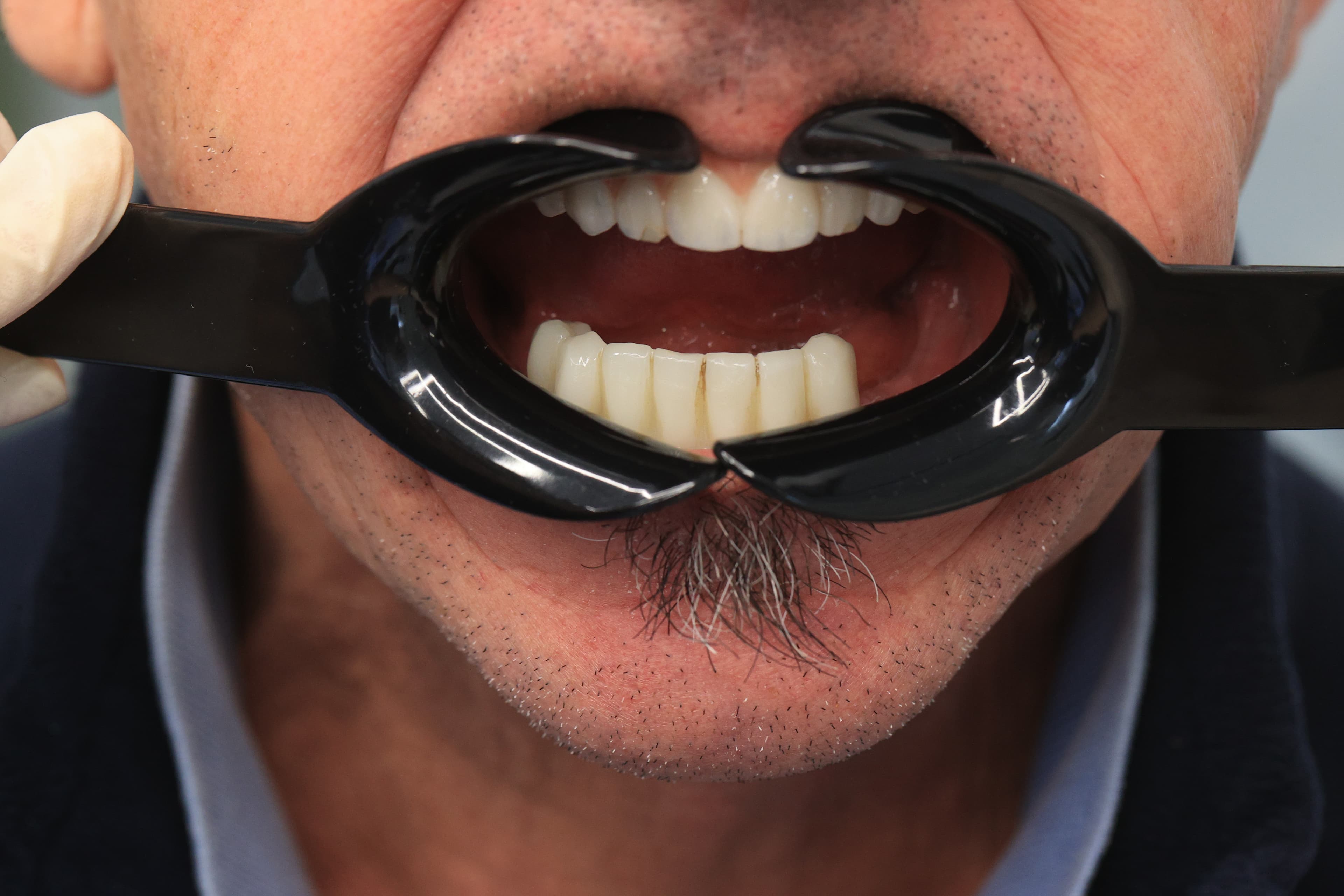 Lela Dental before and after treatment result before