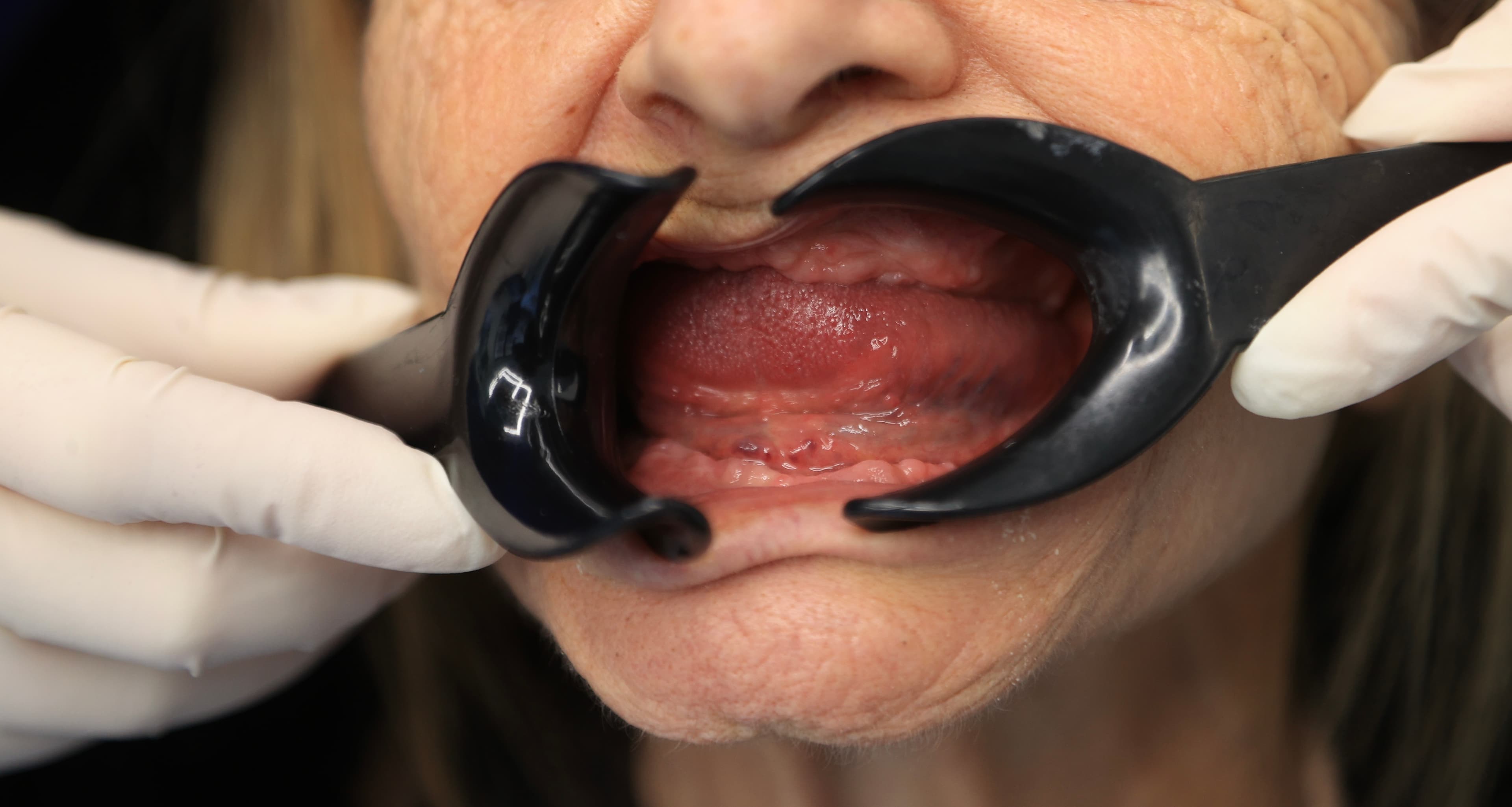 Lela Dental before and after treatment result before