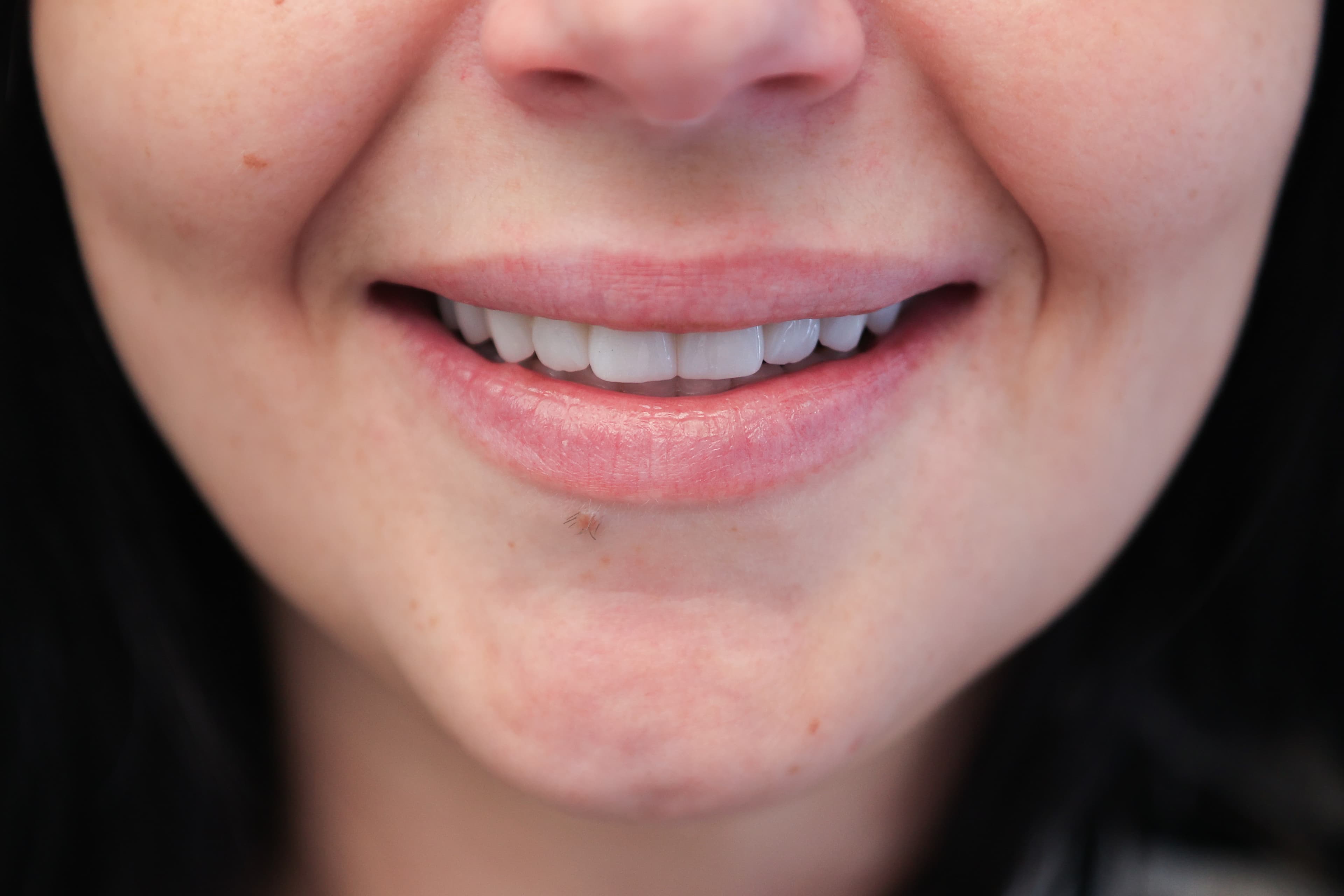Lela Dental before and after treatment result after